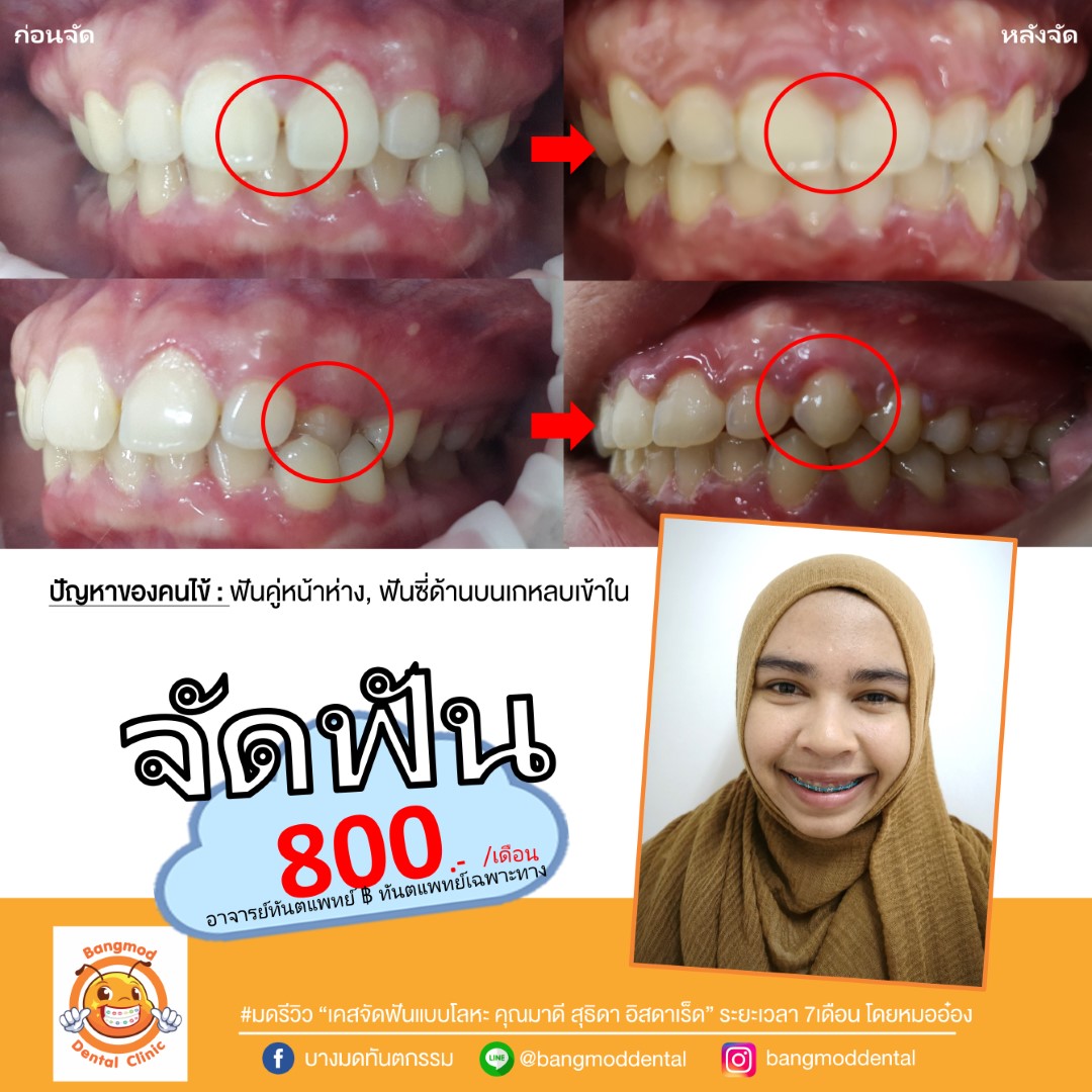 รีวิวจัดฟัน u2013 Bangmod Dental Clinic u2013 บางมดทันตกรรม