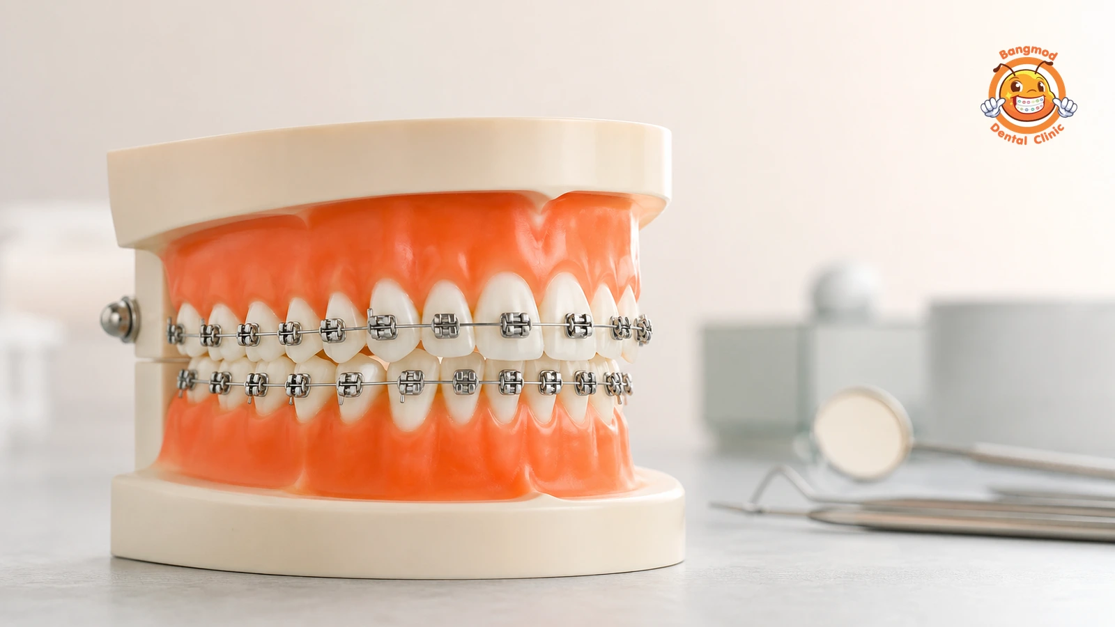 damon braces featured damon braces featured