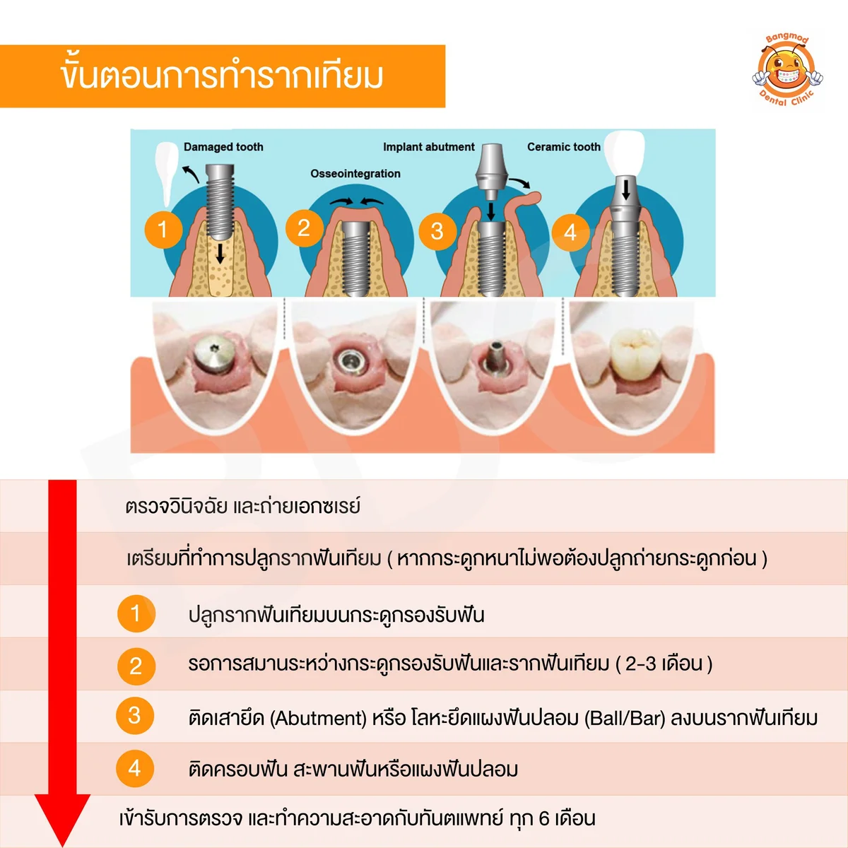 dental implant procedure steps diagram