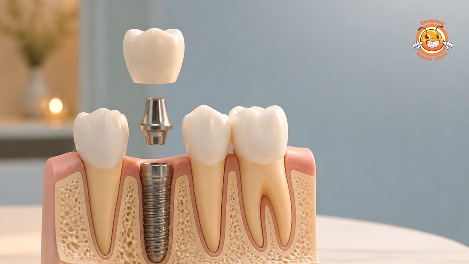 dental implants featured