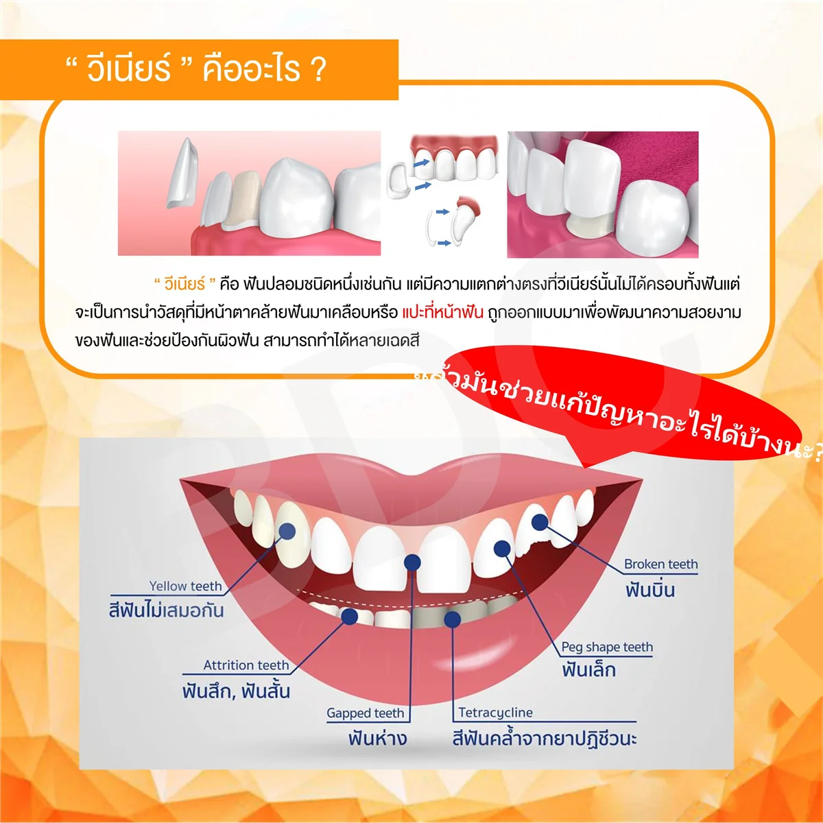 dental veneers explained illustration