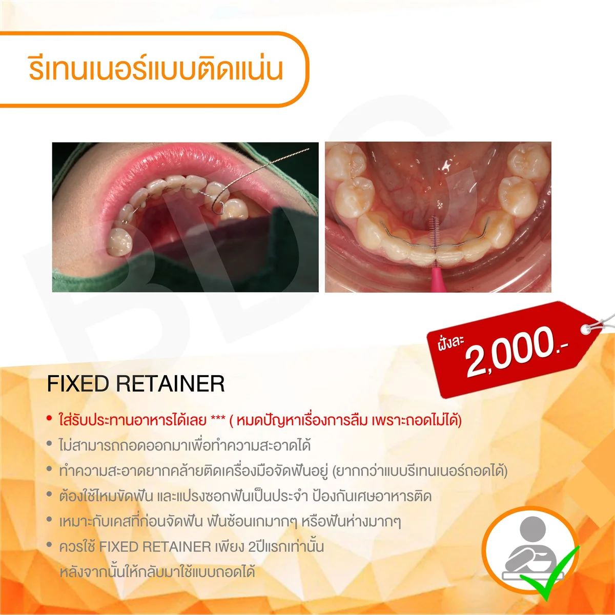 fixed bonded lingual retainer