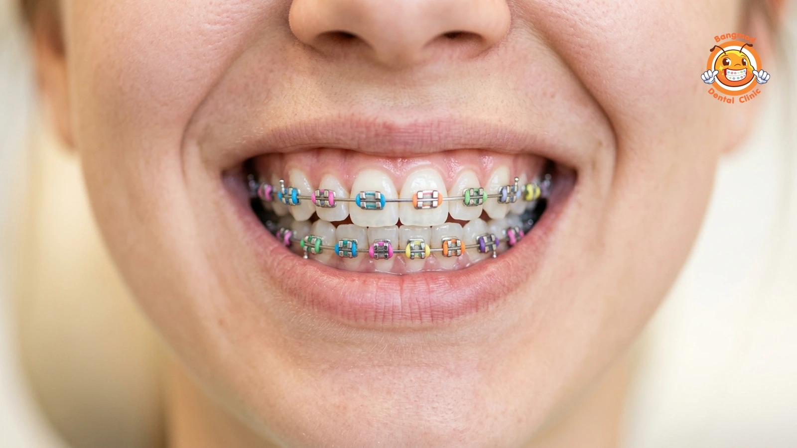metal braces featured