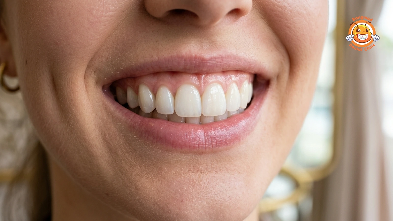 veneers featured